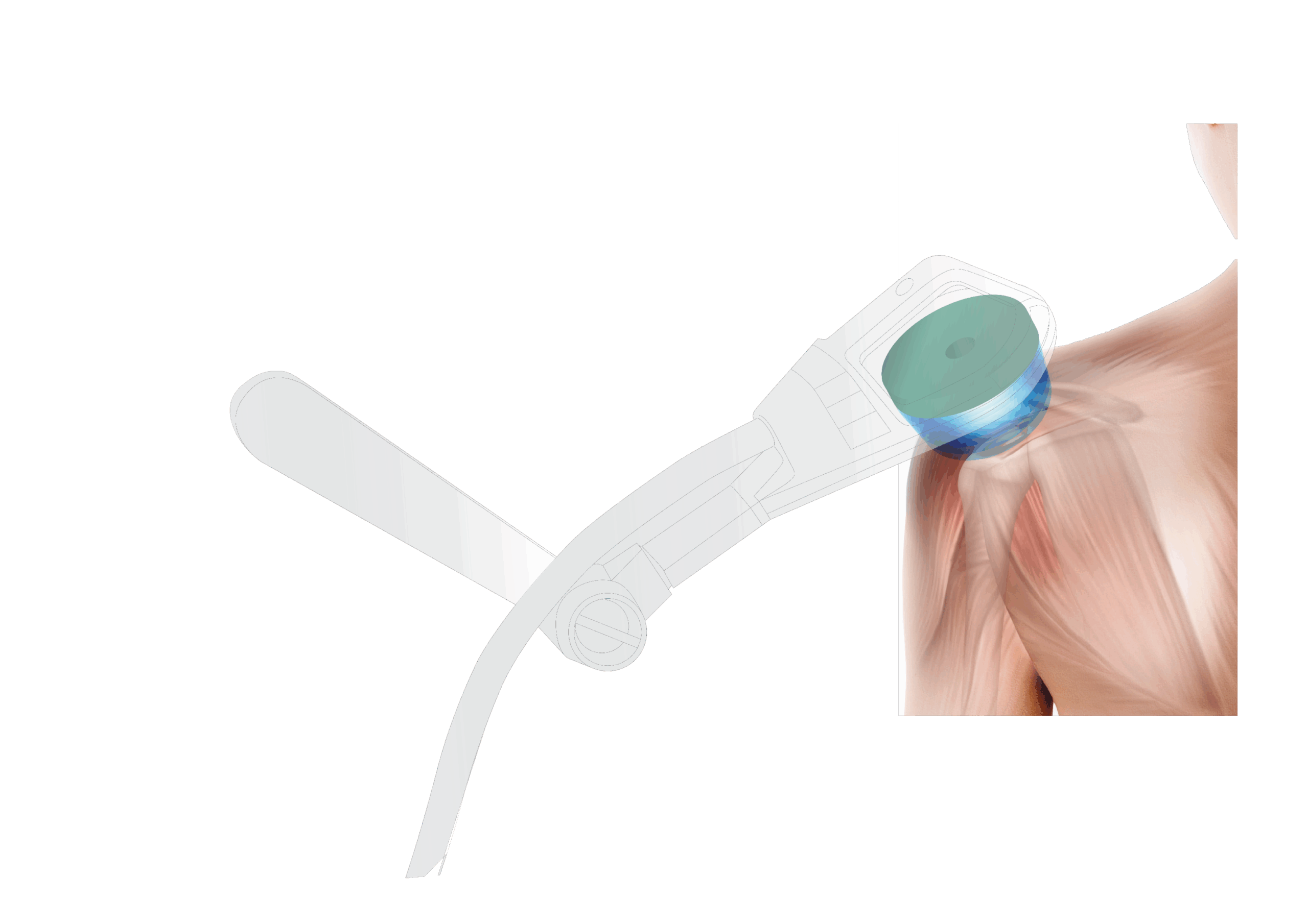 SISとは？（次世代の高強度磁気刺激治療）