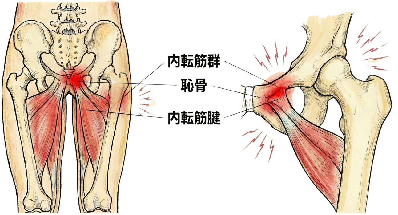 内転筋腱炎