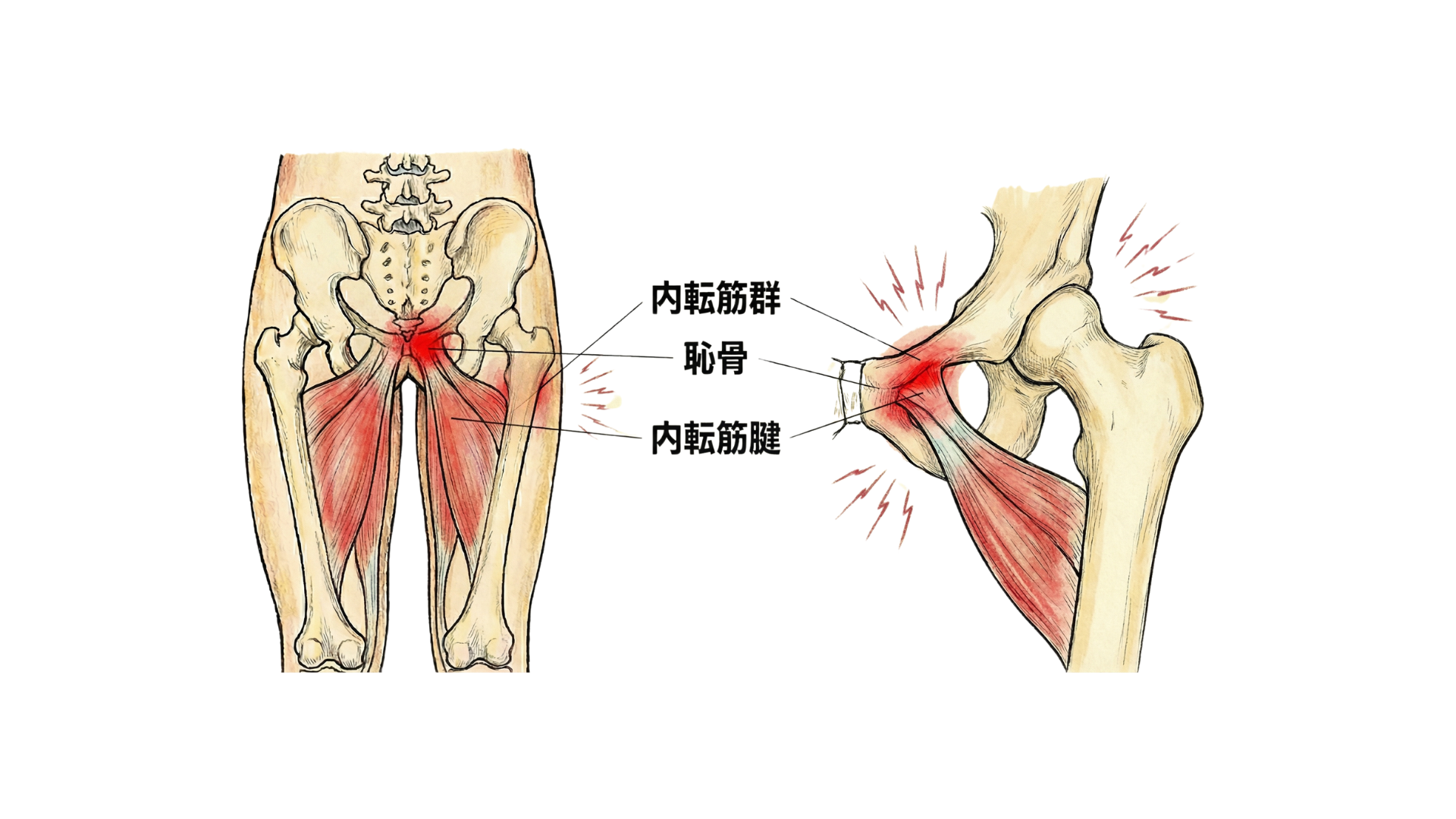 内転筋腱炎