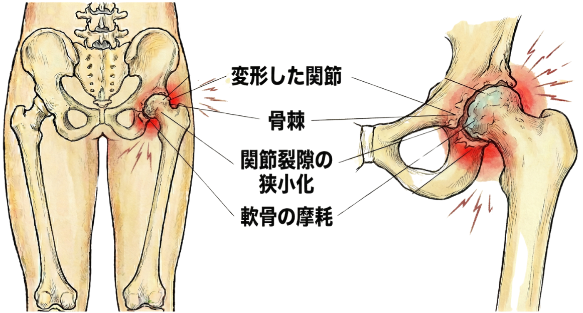 変形性股関節症