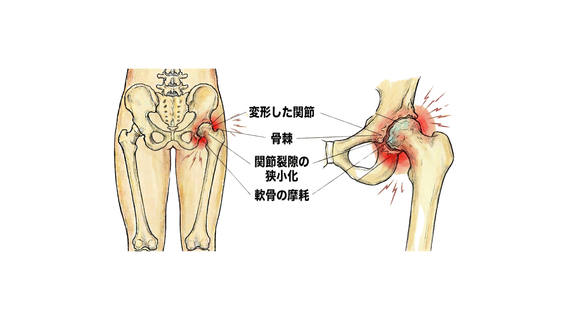 変形性股関節症