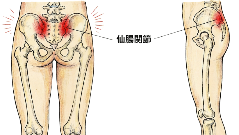 仙腸関節炎　