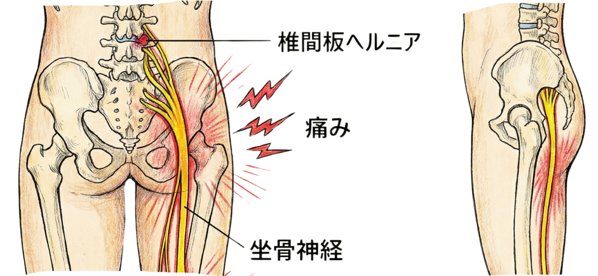坐骨神経痛