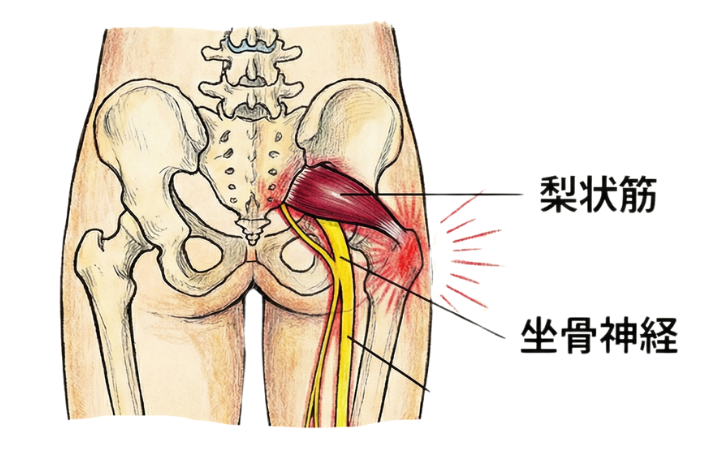 梨状筋症候群