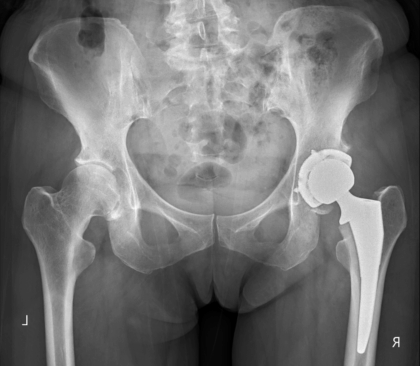 右人工股関節置換術後