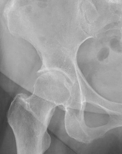 進行期股関節症