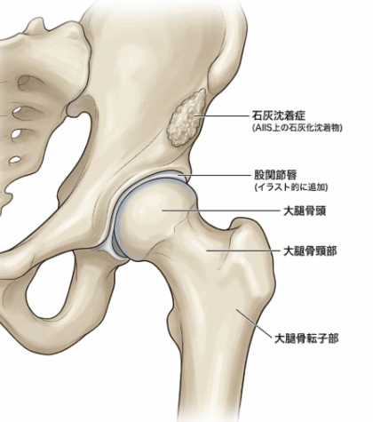 下前腸骨棘石灰沈着症